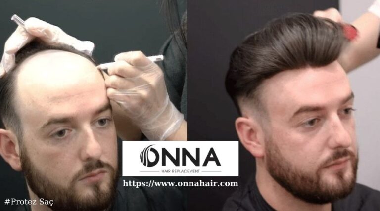 Protez Saç Kullananların Saç Stilinde Renkli Denemeler