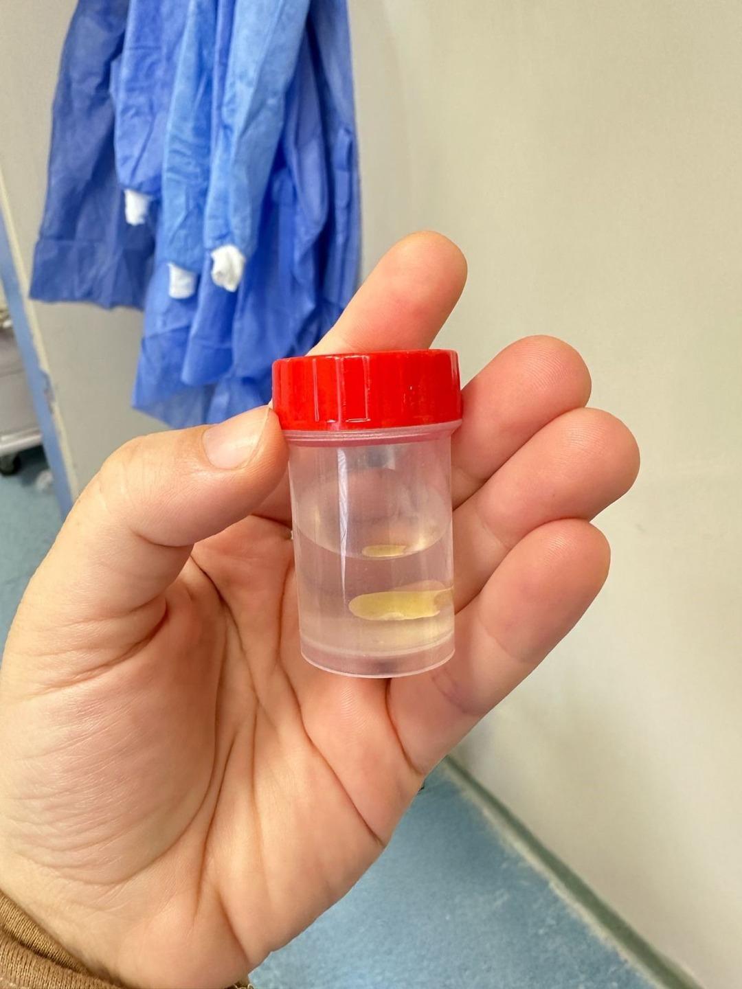 Yedik yiyecek hayatından daha azdı: sağ akciğer tamamen kapalıydı! Trakea'yı engellediğinde 5 ay sonra ortaya çıktı ... 2