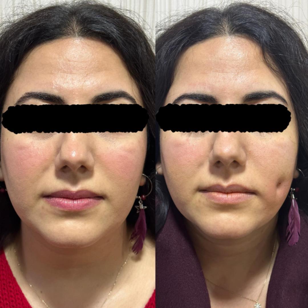 Yeni Estetik Mani: Gamzeplasti cerrahisi sosyal medyaya yayılıyor! 2